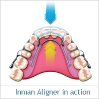 Inman Aligner Action