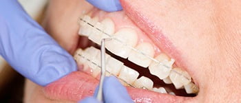 cosmetic braces, Cosmetic Braces