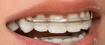 cosmetic braces, Cosmetic Braces