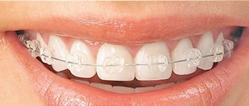cosmetic braces, Cosmetic Braces