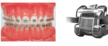 cosmetic braces, Cosmetic Braces